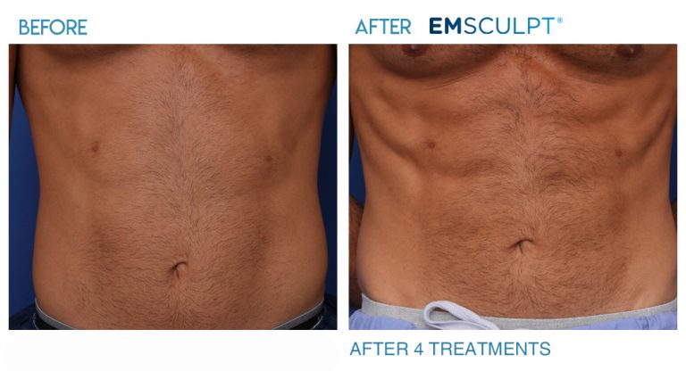 Renewal Skin Spa | Emsculpt-abs-before-and-after