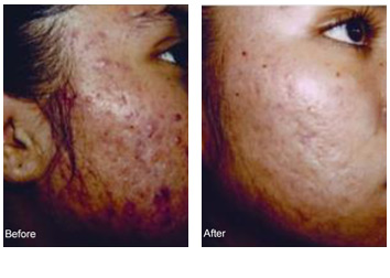 Chemical Peels Treatment for Acne Scars Near Me in Aptos CA